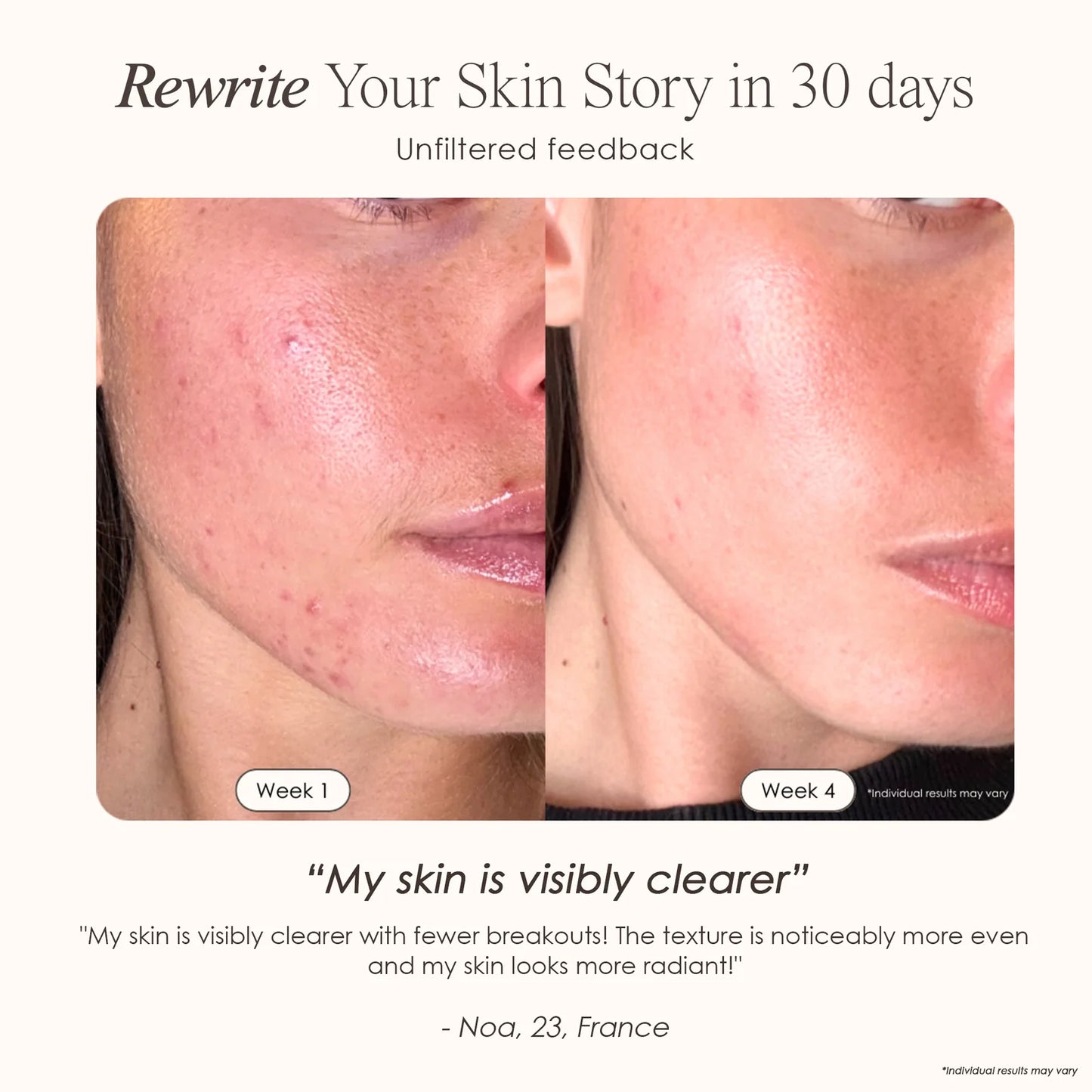 Woman displaying skin results from Revalio LED Face Mask treatments.