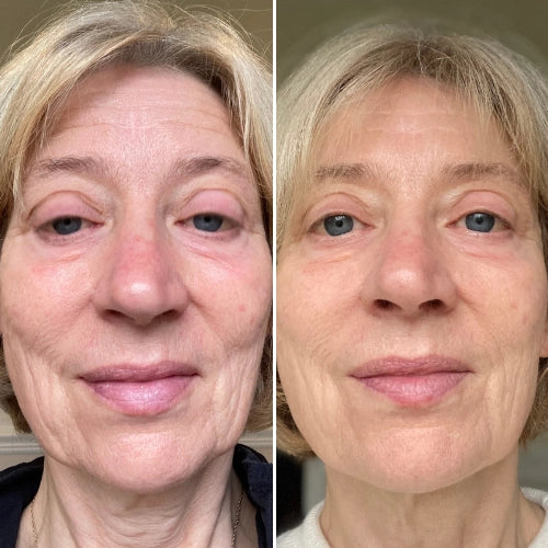 Reduces fine lines and wrinkles