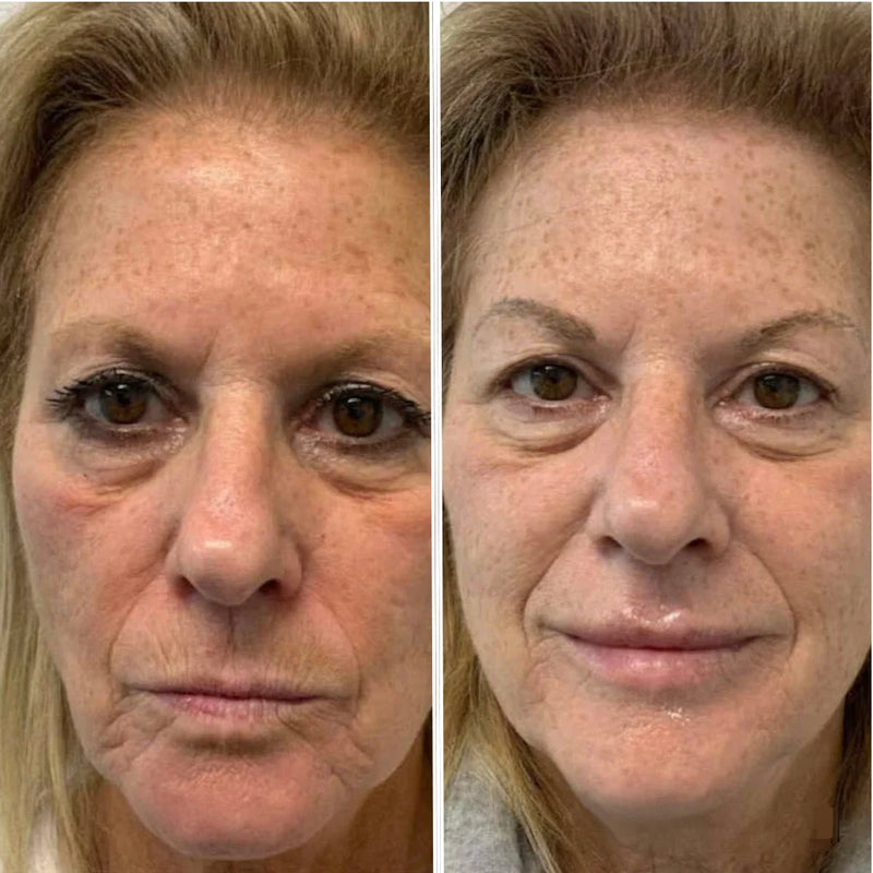 Reduces Fine Lines and Wrinkles