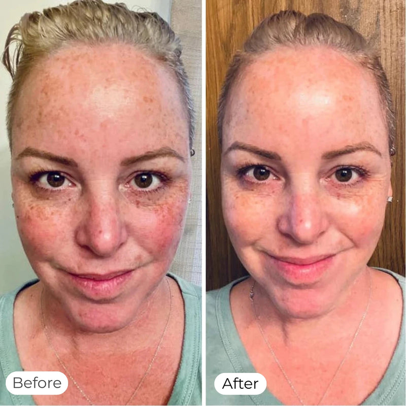 Tone & Redness Improvement